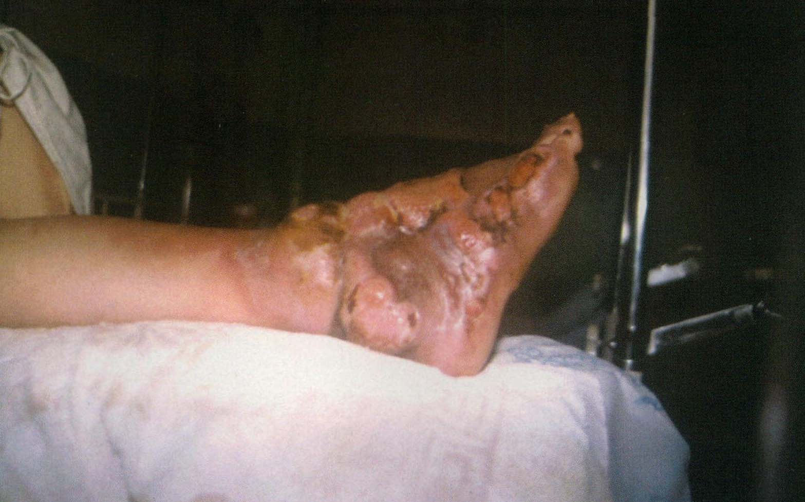 足菌腫